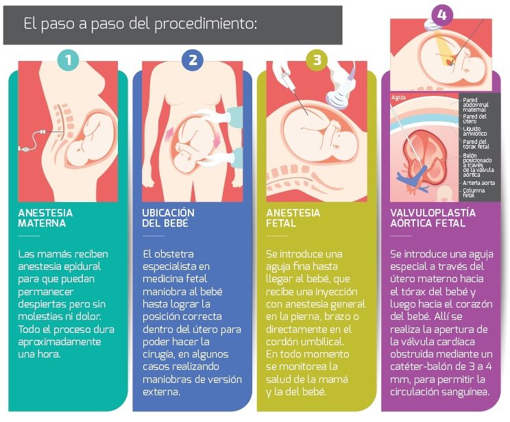 intervencion cardiaca fetal