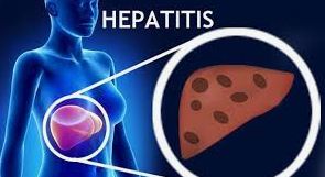 hepatitis